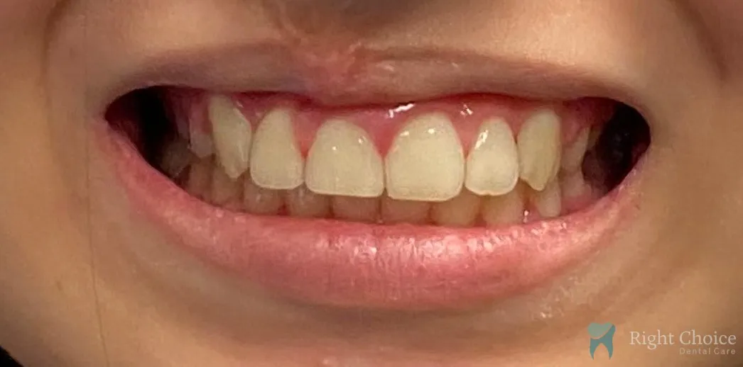 RCDC-01-E-Nicole-after