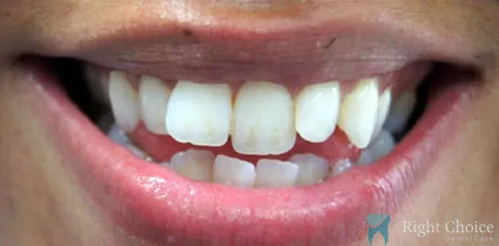 Right-Choice-Braces-Invisalign-Case-02-before