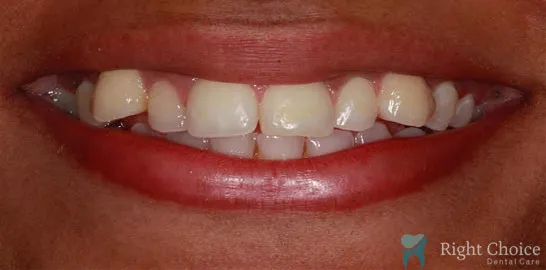 Right-Choice-Braces-Invisalign-Case-03-before