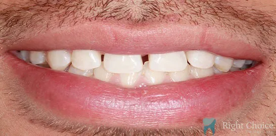 Right-Choice-Braces-Invisalign-Case-04-before