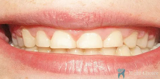 Right-Choice-Braces-Invisalign-Case-05-after