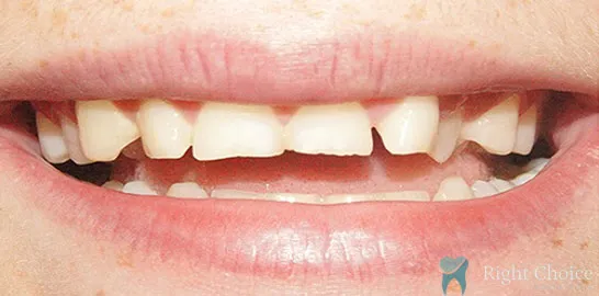 Right-Choice-Braces-Invisalign-Case-05-before