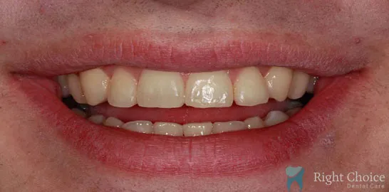 Right-Choice-Braces-Invisalign-Case-06-after