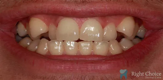 Right-Choice-Braces-Invisalign-Case-06-before