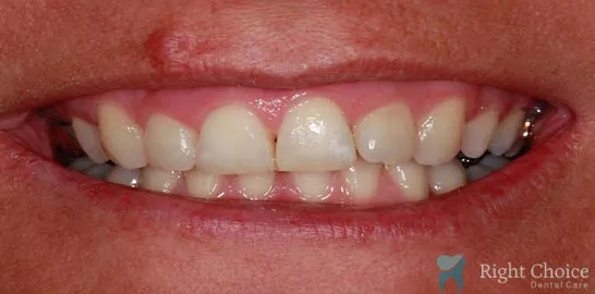 Right-Choice-Braces-Invisalign-Case-07-after