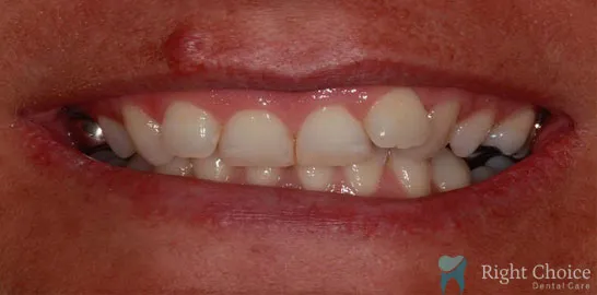 Right-Choice-Braces-Invisalign-Case-07-before