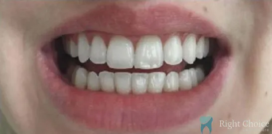 Right-Choice-Braces-Invisalign-Case-08-after