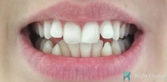 Right-Choice-Braces-Invisalign-Case-08-before
