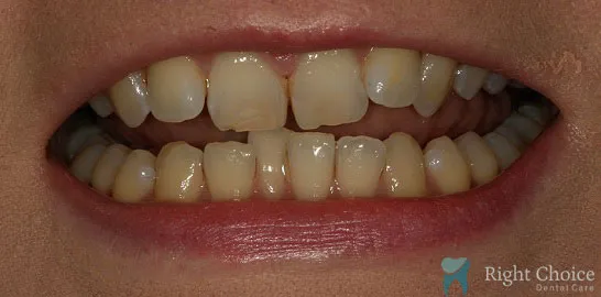 Right-Choice-Braces-Invisalign-Case-09-before