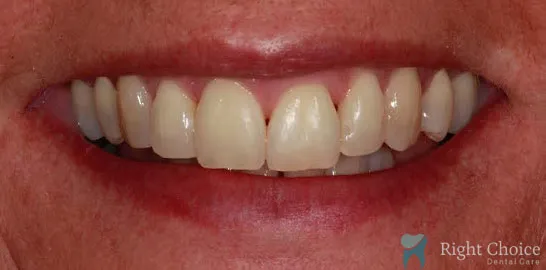 Right-Choice-Braces-Invisalign-Case-10-after