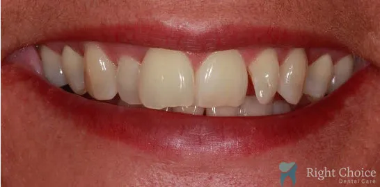 Right-Choice-Braces-Invisalign-Case-10-before