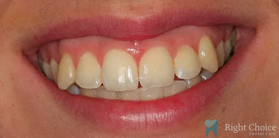 Right-Choice-Braces-Invisalign-Case-12-before