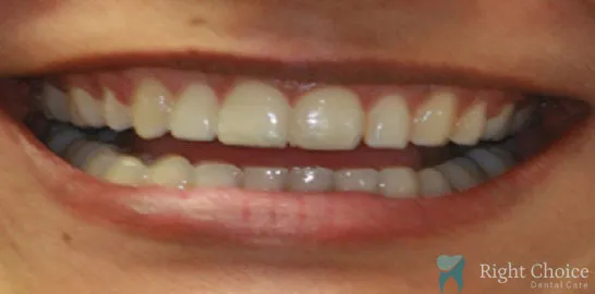 Right-Choice-Braces-Invisalign-Case-15-after