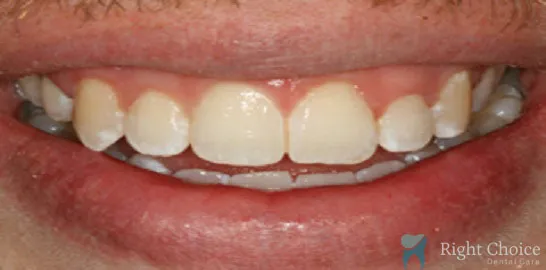 Right-Choice-Braces-Invisalign-Case-16-after