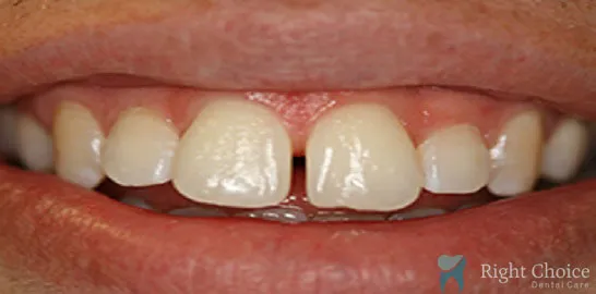 Right-Choice-Braces-Invisalign-Case-16-before
