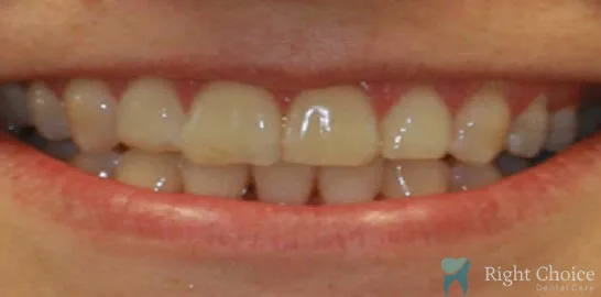 Right-Choice-Braces-Invisalign-Case-17-after