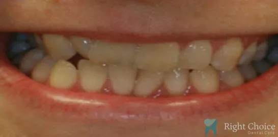 Right-Choice-Braces-Invisalign-Case-17-before