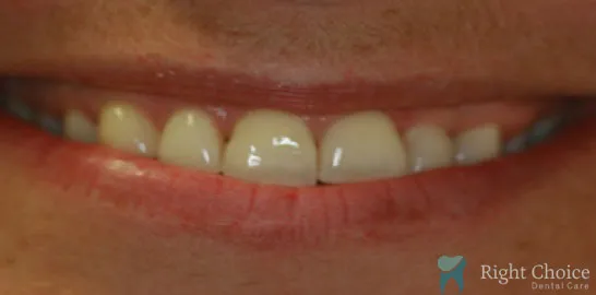 Right-Choice-Braces-Invisalign-Case-18-after