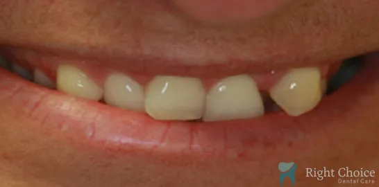 Right-Choice-Braces-Invisalign-Case-18-before